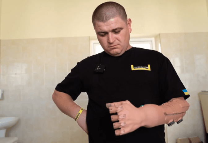 У Львові пацієнту встановили найлегший у світі протез, надрукований на 3D-принтері