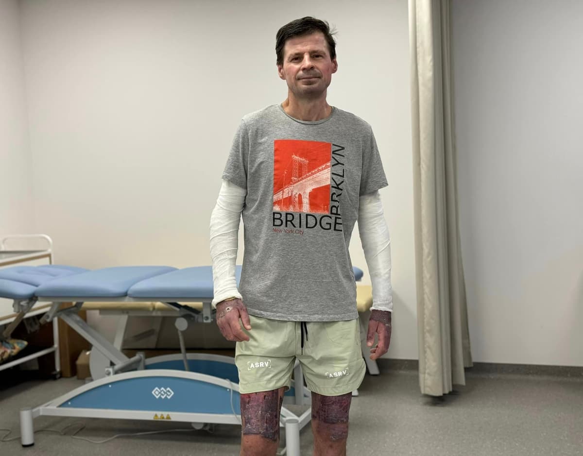 Львівські лікарі врятували чоловіка, який обпік майже половину тіла