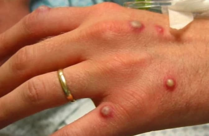 Чи можливе поширення мавпячої віспи на Львівщині. Пояснення