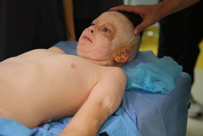 У Львові провели 36-ту операцію хлопчику, який постраждав від ракетного удару у 2022 році