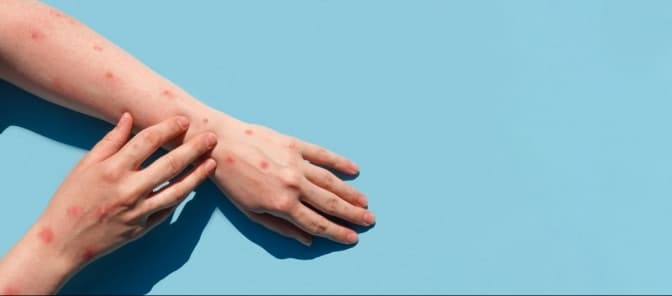 Як передається та чим небезпечна мавпяча віспа. Пояснення МОЗ