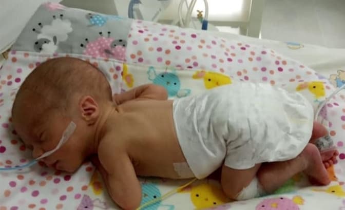 У львівському пологовому успішно виходили передчасно народжене немовля із вродженою пневмонією