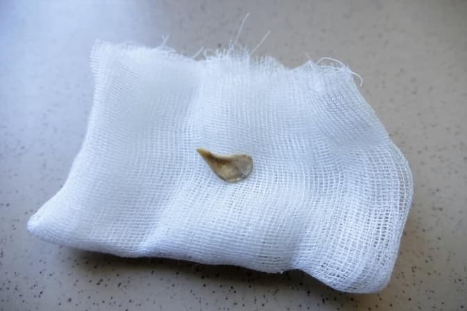 Львівські медики врятували жінку, яка місяць прожила з кісткою в дихальних шляхах