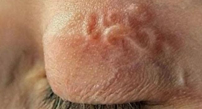 Львівські медики витягнули 11-сантиметрового паразита з ока чоловіка