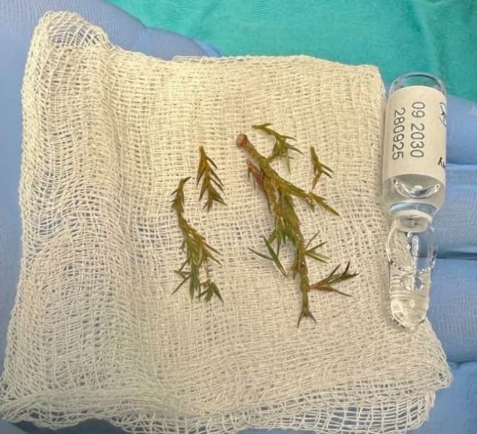 Львівські лікарі витягли з дихальних шляхів 8-місячного малюка гілку ялинки