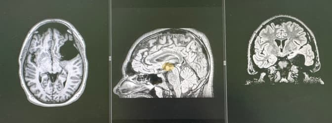 Львівські нейрохірурги прооперували підлітка з рідкісною пухлиною мозку