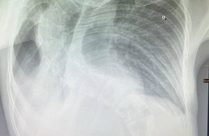 Викривлений хребет здавлював легеню: у Львові врятували 13-річну дівчинку