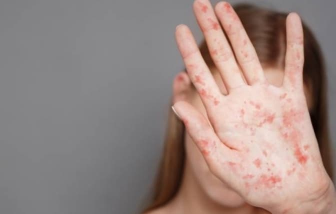 У Києві понад 6 тисяч дітей не мають щеплення проти кору