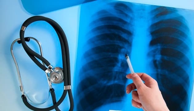 Медики розповіли, яка ситуація з туберкульозом на Львівщині і хто хворіє