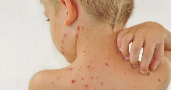 У Польщі підтвердили перший випадок мавпячої віспи