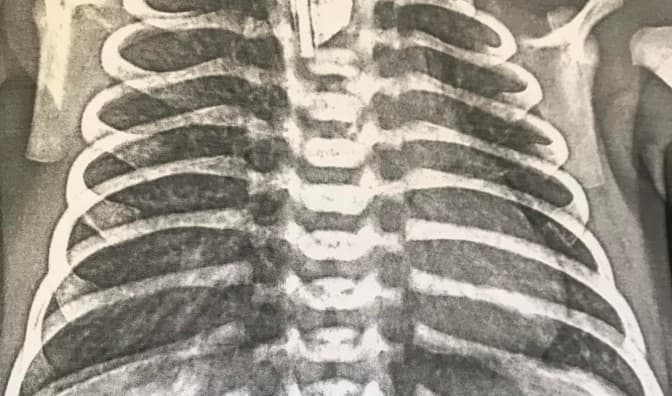 Львівські хірурги планують сформувати новонародженому хлопчику «штучний стравохід»