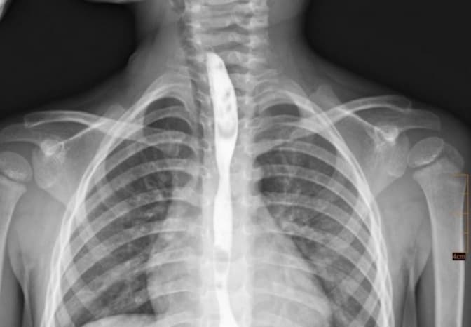 У Львові протягом двох років рятували хлопчика, який випадково випив побутову хімію