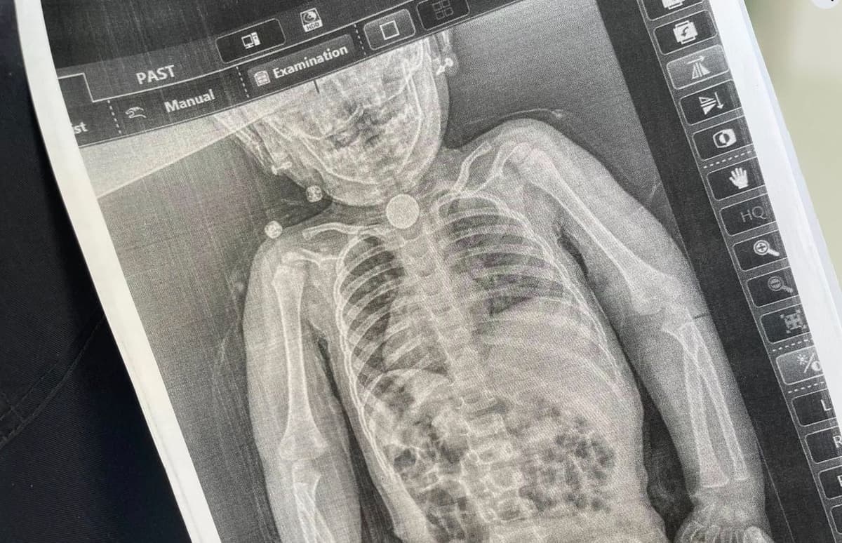 У Львові хірурги врятували 2-річну дівчинку, яка три місяці жила з батарейкою у стравоході