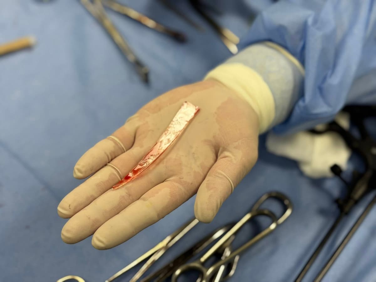 У Львові хірурги дістали 10-сантиметровий уламок скла з легені пораненого під час атаки 24 березня