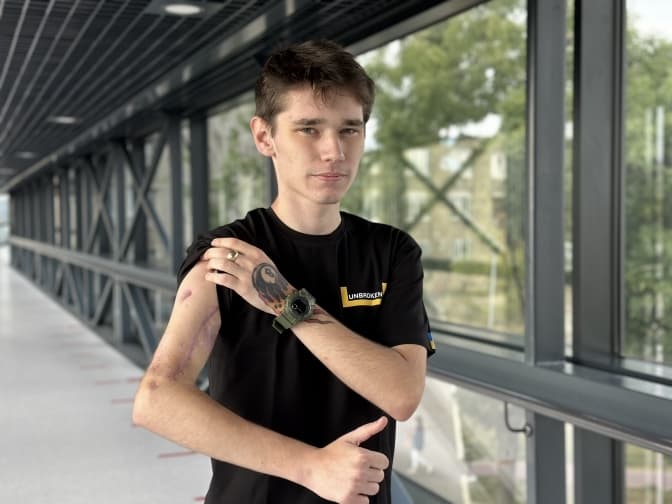 21-річний військовий зі Львова був у полоні й міг втратити руку. Лікарям вдалось допомогти