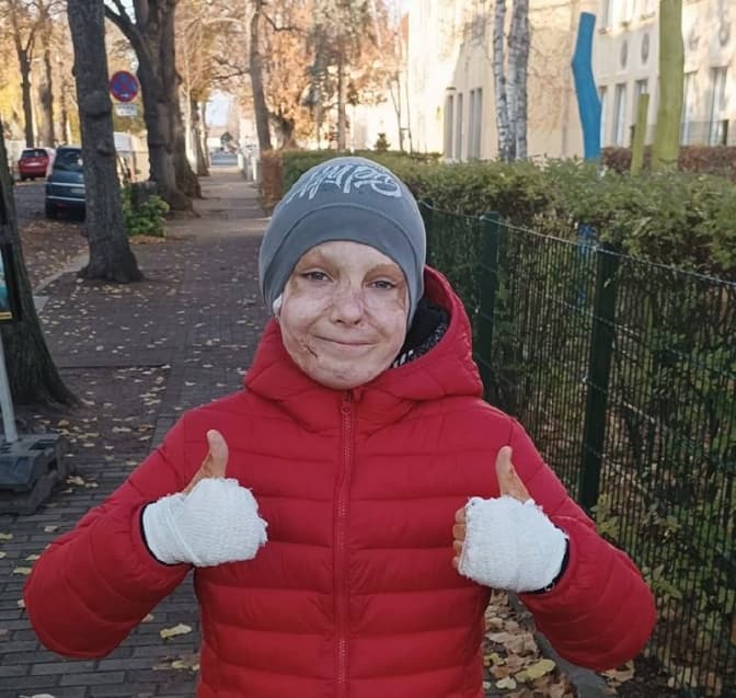Хлопчик зі Львова, який отримав опіки внаслідок ракетного удару, зняв маску проти рубців