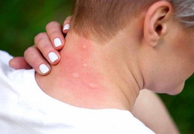 На Львівщині зростає захворюваність на дирофіляріоз. Що потрібно знати