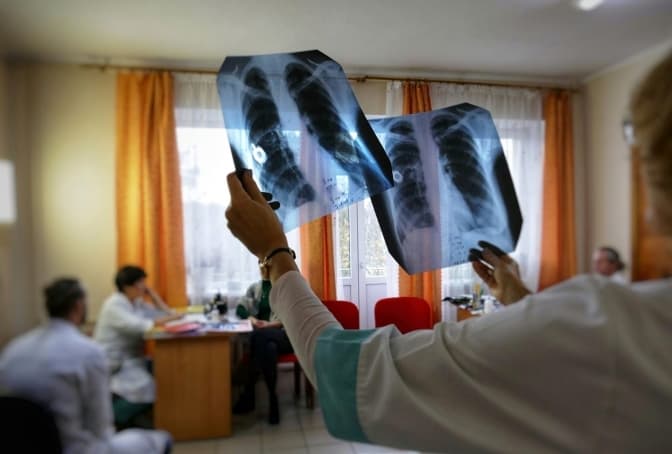 На Львівщині різко знизилося виявлення випадків туберкульозу. З чим це пов’язано