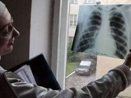 У Львові кількість хворих на туберкульоз залишилась на минулорічному рівні