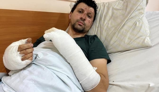 У опіковому центрі Львова лікують двох чоловіків після вибухів акумуляторів в помешканнях