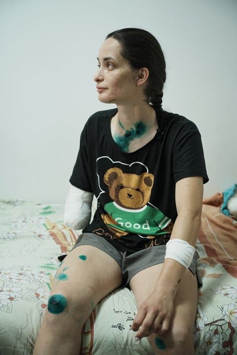 Рятувальниця Олександра Щебілова проходить лікування після важкого поранення після удару РФ 15 червня, Харків, 19 червня 2026 року. /Фото: Суспільне Харків