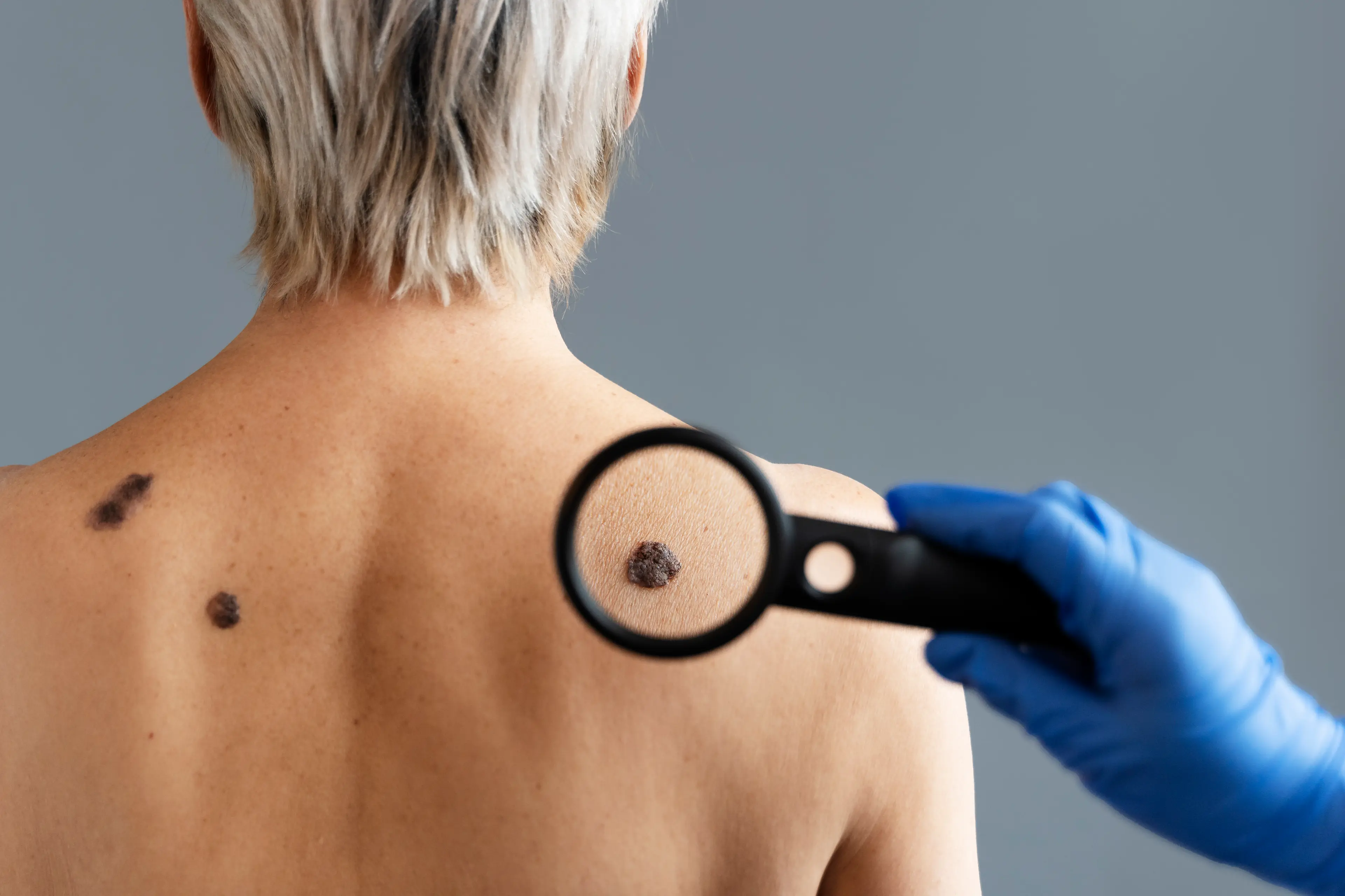 Лікарі радять не зволікати із діагностикою родимок / фото Freepik