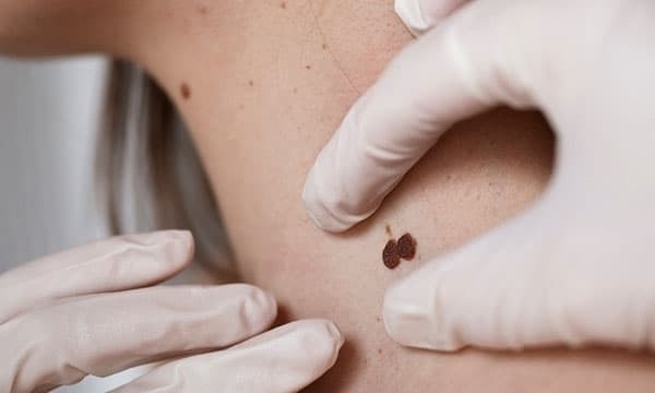 У Львові завтра безкоштовно перевірятимуть родимки. Коли та де