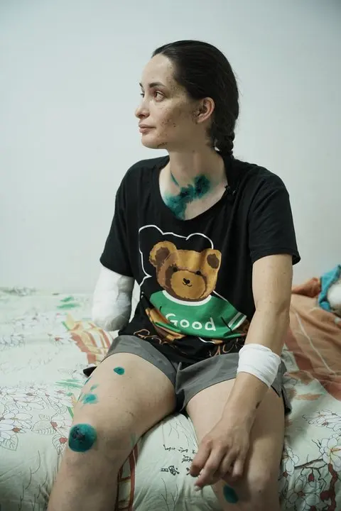 Рятувальниця Олександра Щебілова проходить лікування після важкого поранення після удару РФ 15 червня, Харків, 19 червня 2026 року. /Фото: Суспільне Харків