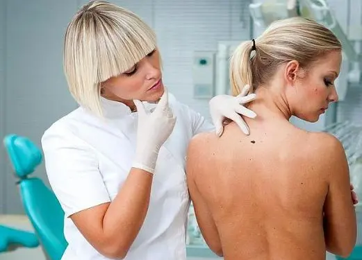 Стоп меланома. Мешканців Львівщини закликають безкоштовно обстежити родимки