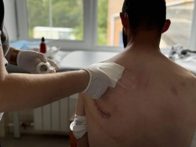 Львівські лікарі скріпили уламки кісток чоловіку, який міг втратити здатність рухати рукою