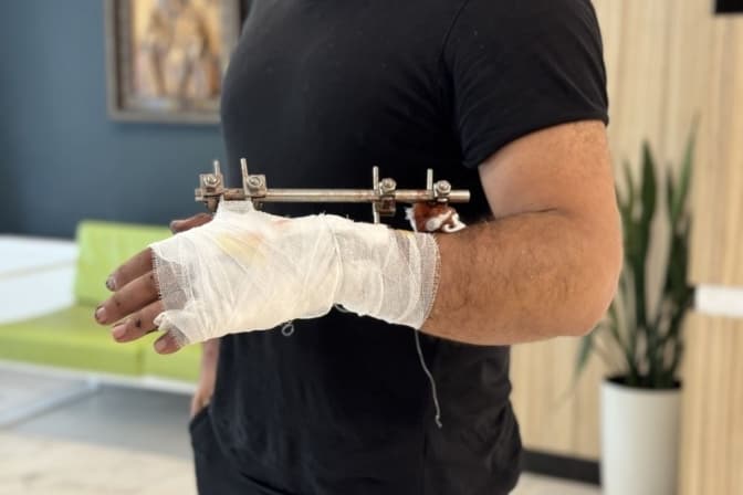 Лікарі у Львові врятували руку чоловікові, яку розчавило пресом