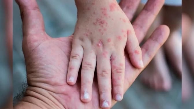 На Львівщині зросла кількість випадків менінгококової інфекції: що варто знати